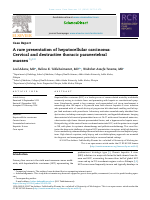 HCC, a case report.pdf